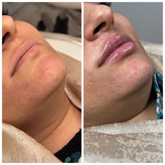 تزریق فیلر لب (5)