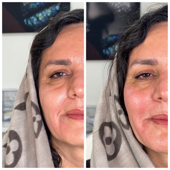 تزریق فیلر