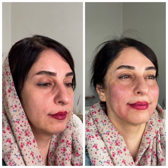 تزریق فیلر (3)