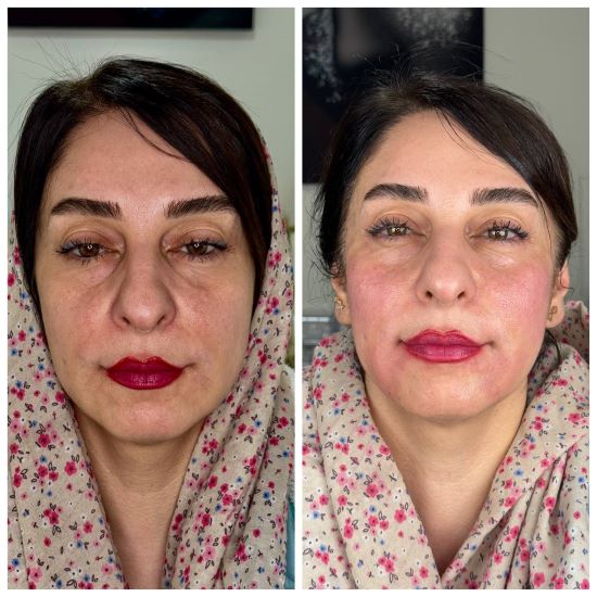 تزریق فیلر (4)
