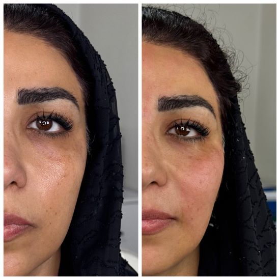 تزریق فیلر (5)