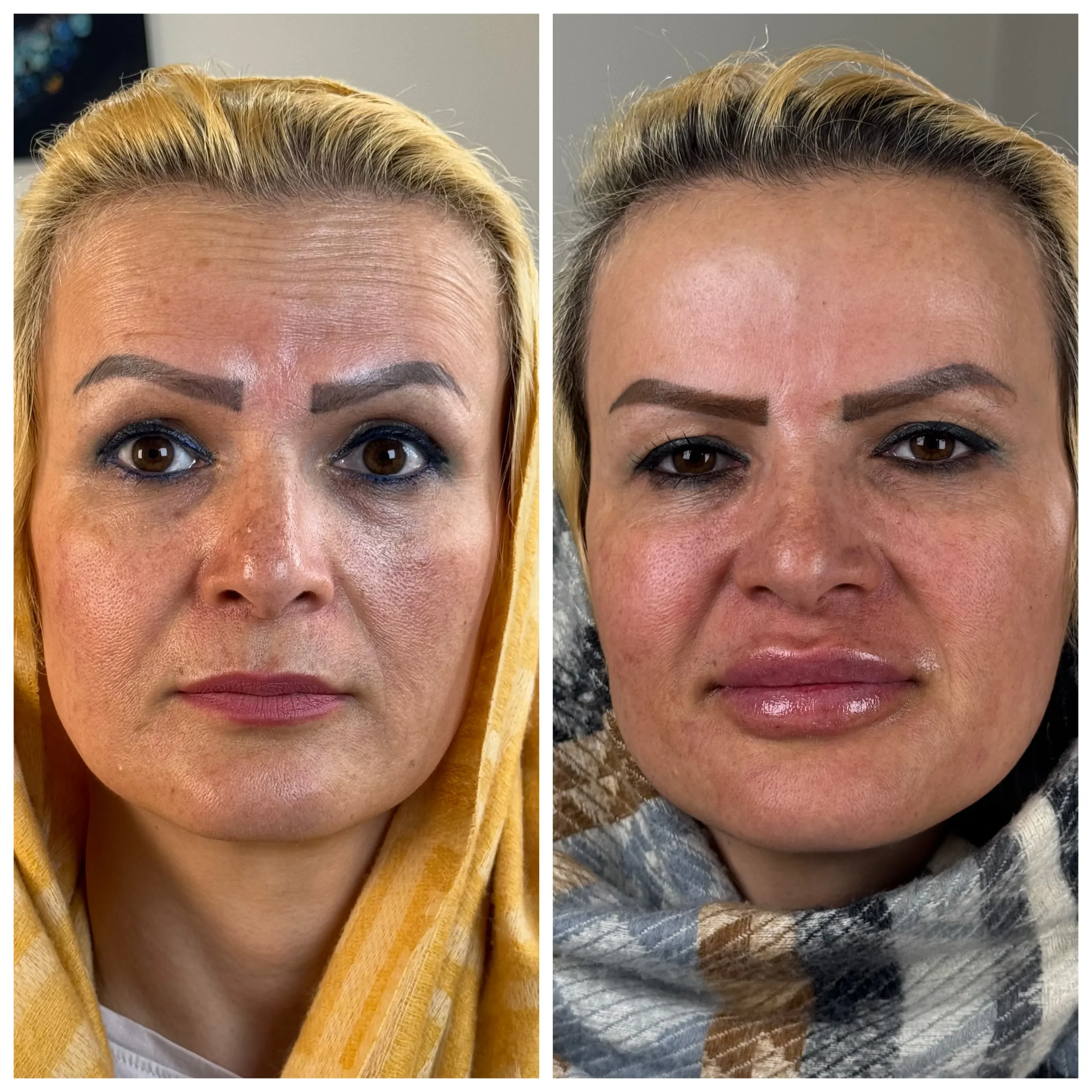 بوتاکس