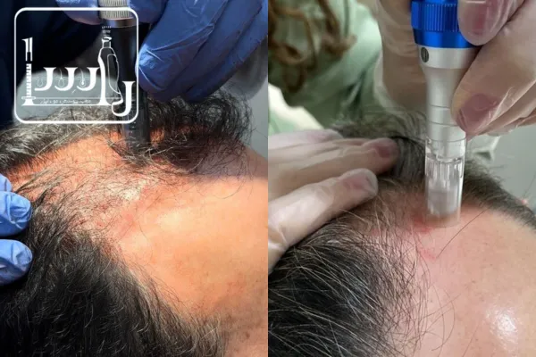 مزوتراپی و پی آر پی مو؛ کدام بهتر است؟
