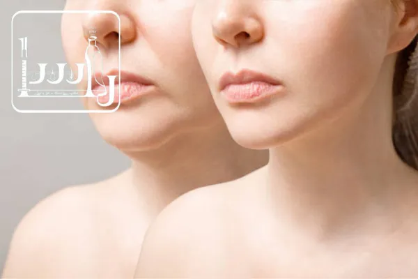 کدام جراحی غبغب را انتخاب کنیم؟