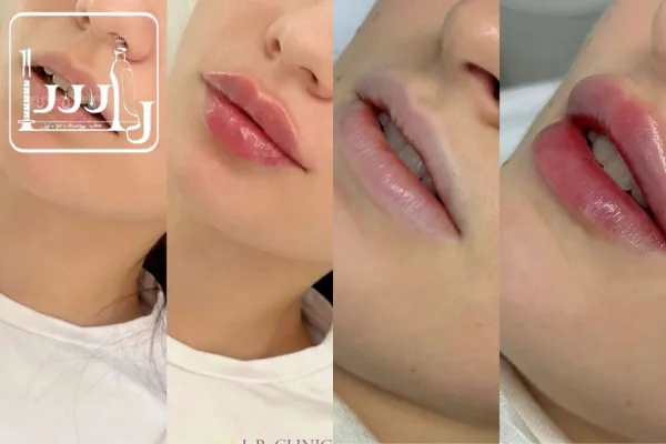 تزریق ژل لب روسی چگونه است؟