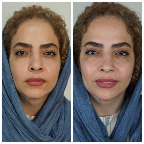 عکس تزریق چربی به صورت​