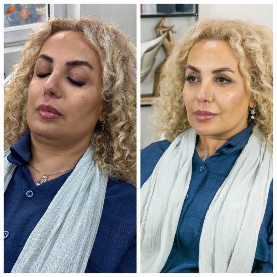 عکس تزریق چربی به صورت​