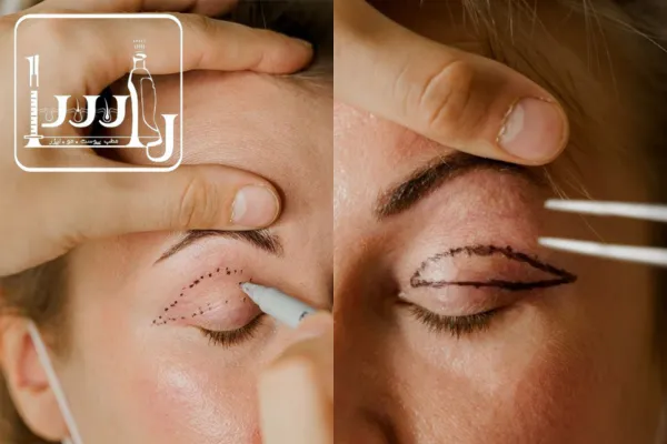 اگر در سن مناسب بلفاروپلاستی نبودید چه روش‌های جایگزینی وجود دارد؟