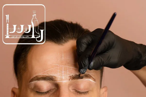 کاشت ابرو به روش FUE