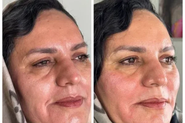 تزریق ژل و فیلر