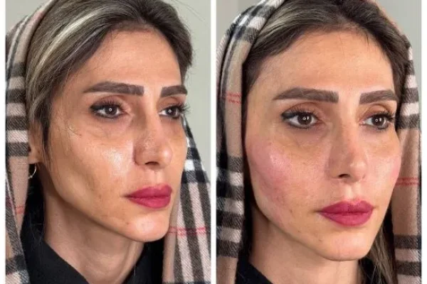 تزریق ژل و فیلر