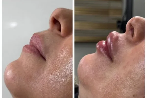 تزریق ژل و فیلر
